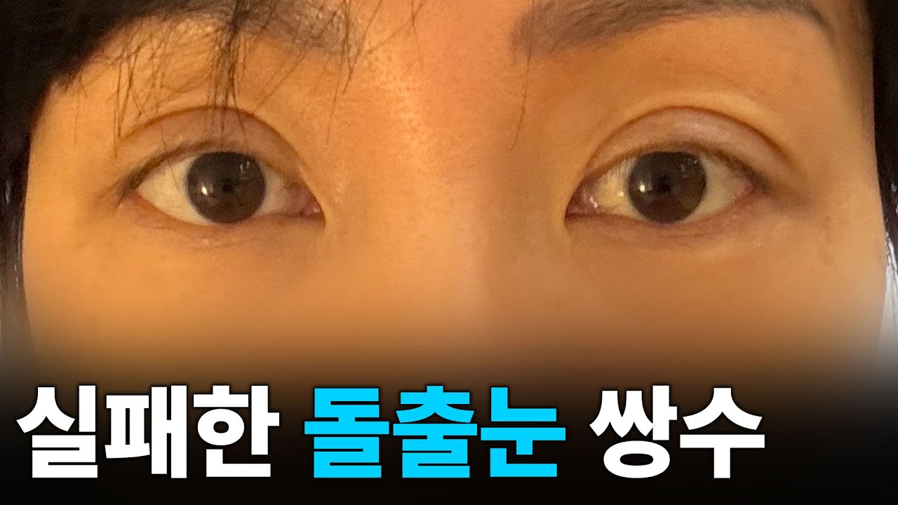 돌출눈 수술이 실패할 수밖에 없던 이유-두상의 차이 그리고 눈의 구조(동양인,서양인)