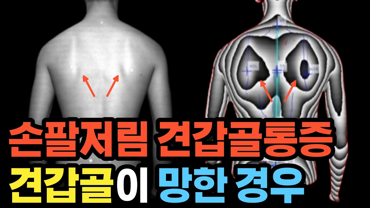 손팔저림 견갑골통증 환자분들이 필수로 아셔야하는 것