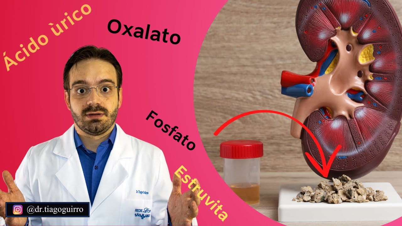 Você Precisa Saber Qual o Tipo do Seu Cálculo Renal!