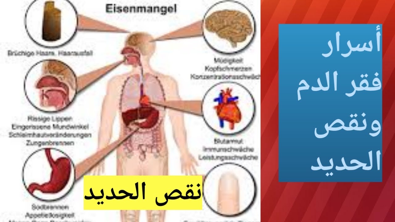 فقر الدم الناتج عن نقص الحديد اسبابه الحقيقية و العلاج الصحيح