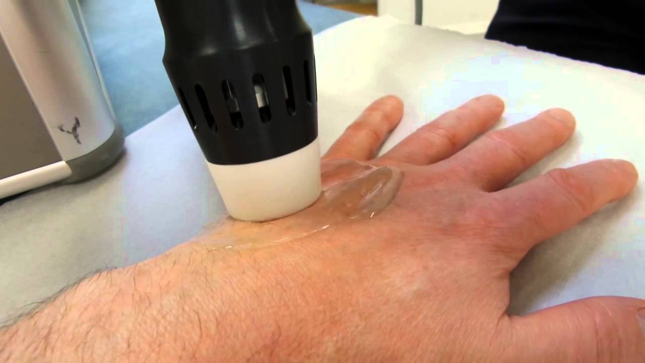 Shock wave therapy to the hand second session (Enraf Nonius 811)