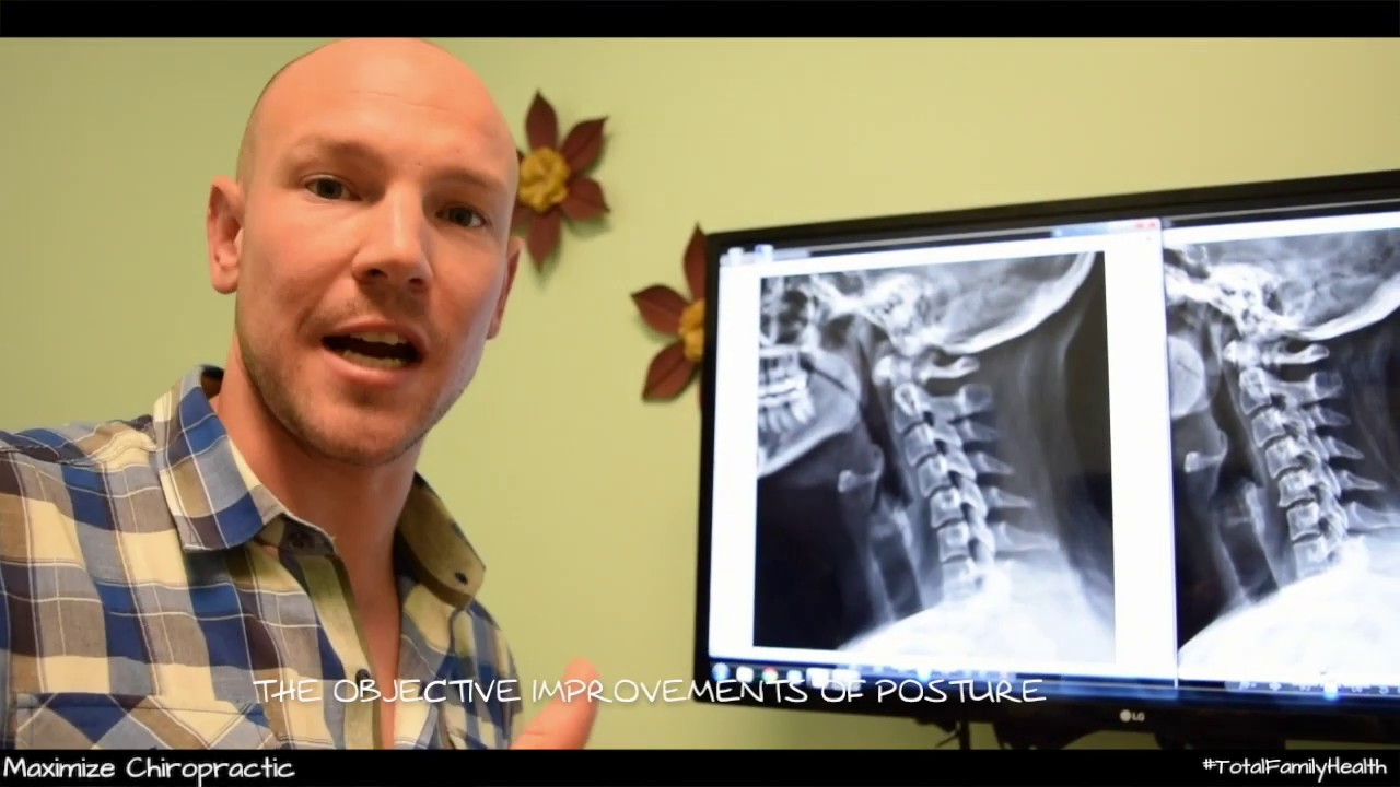 The Benefits of Corrective Chiropractic vs Traditional Chiropractic - DJD in neck