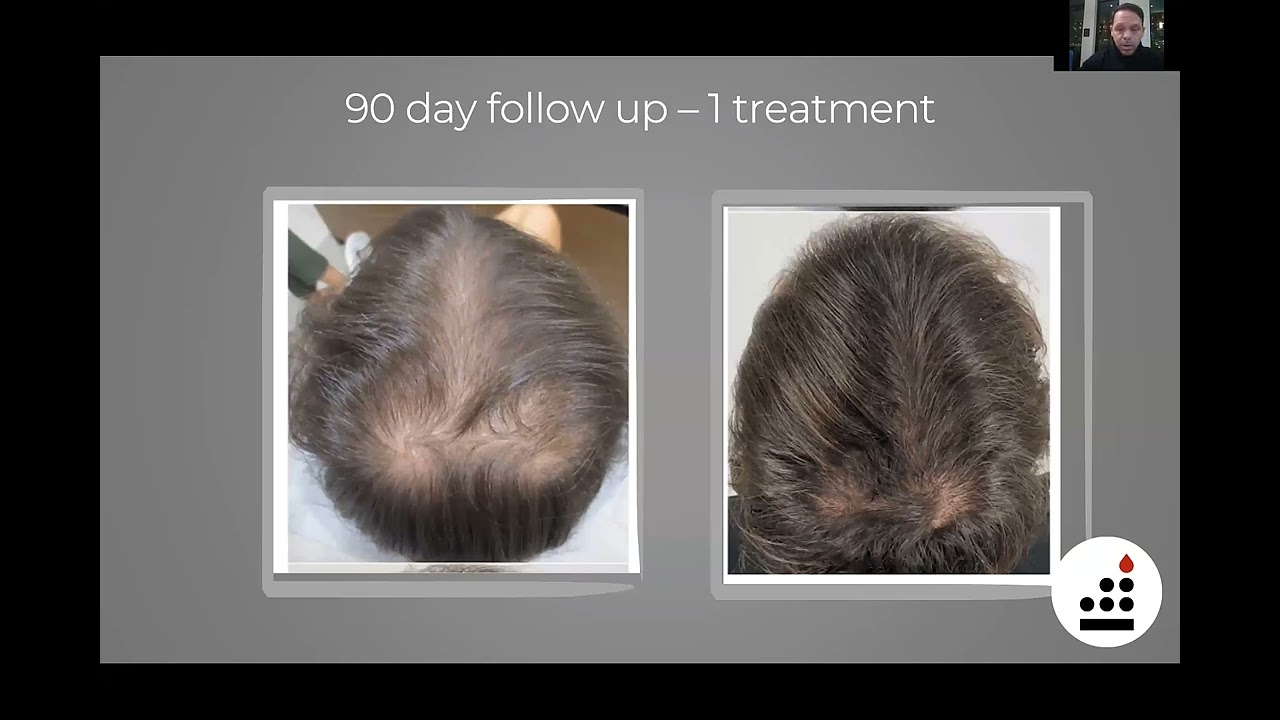 TruDose PRP with Tapley Holland and Dr Mollie James