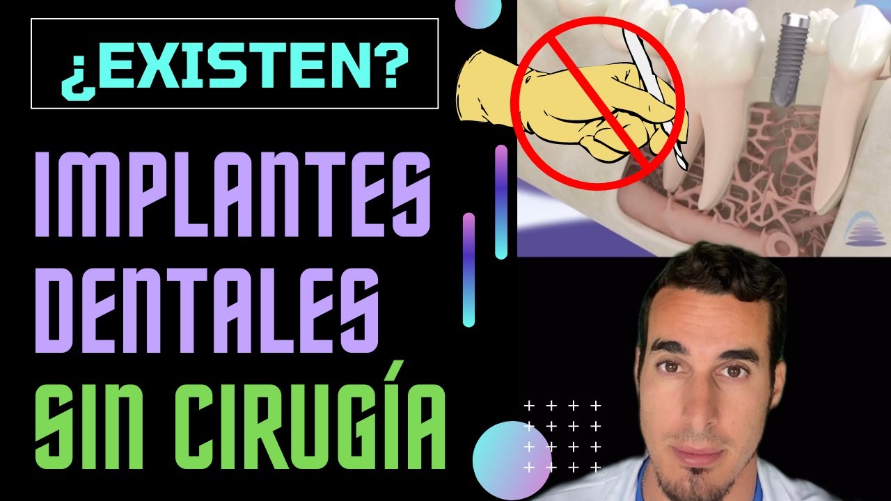 Los IMPLANTES DENTALES sin CIRUGÍA 🚨NO EXISTEN🚨 - Que no te engañen 