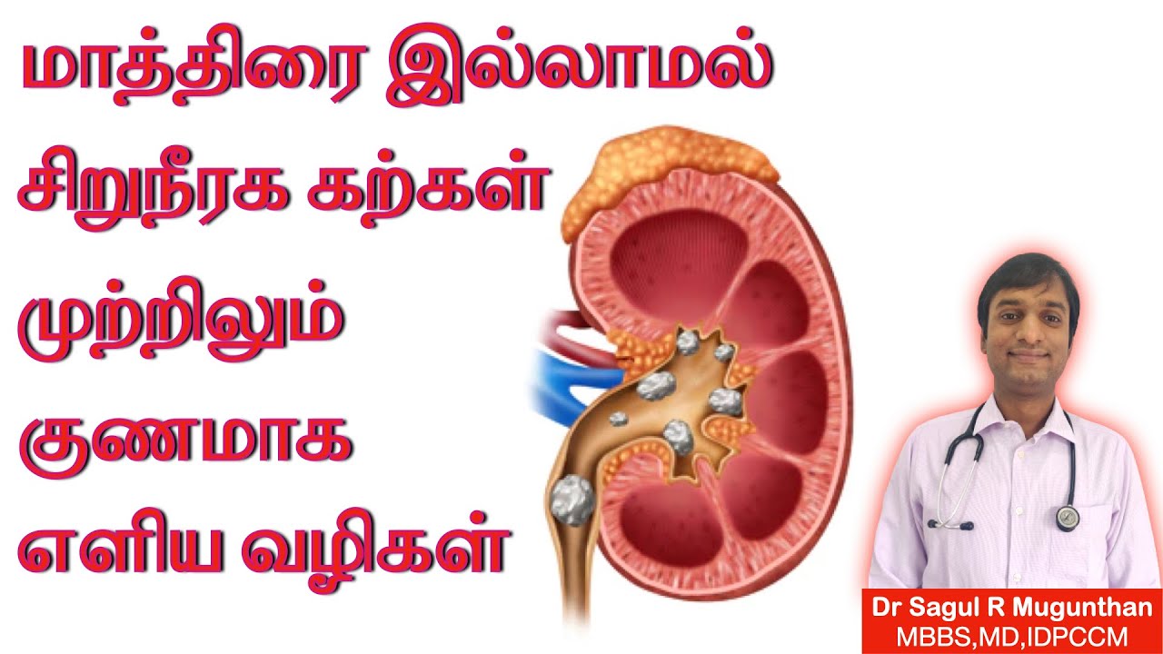 சிறுநீரக கற்கள் குணமாக எளிய வழிகள் | Kidney stones treatment in TAMIL