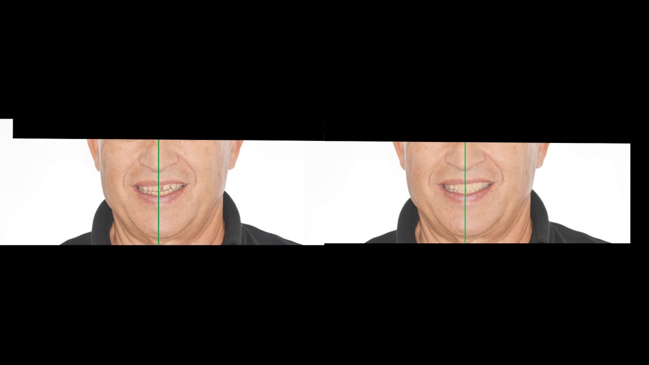 3-Arco facial+Fotografías+Plano oclusal