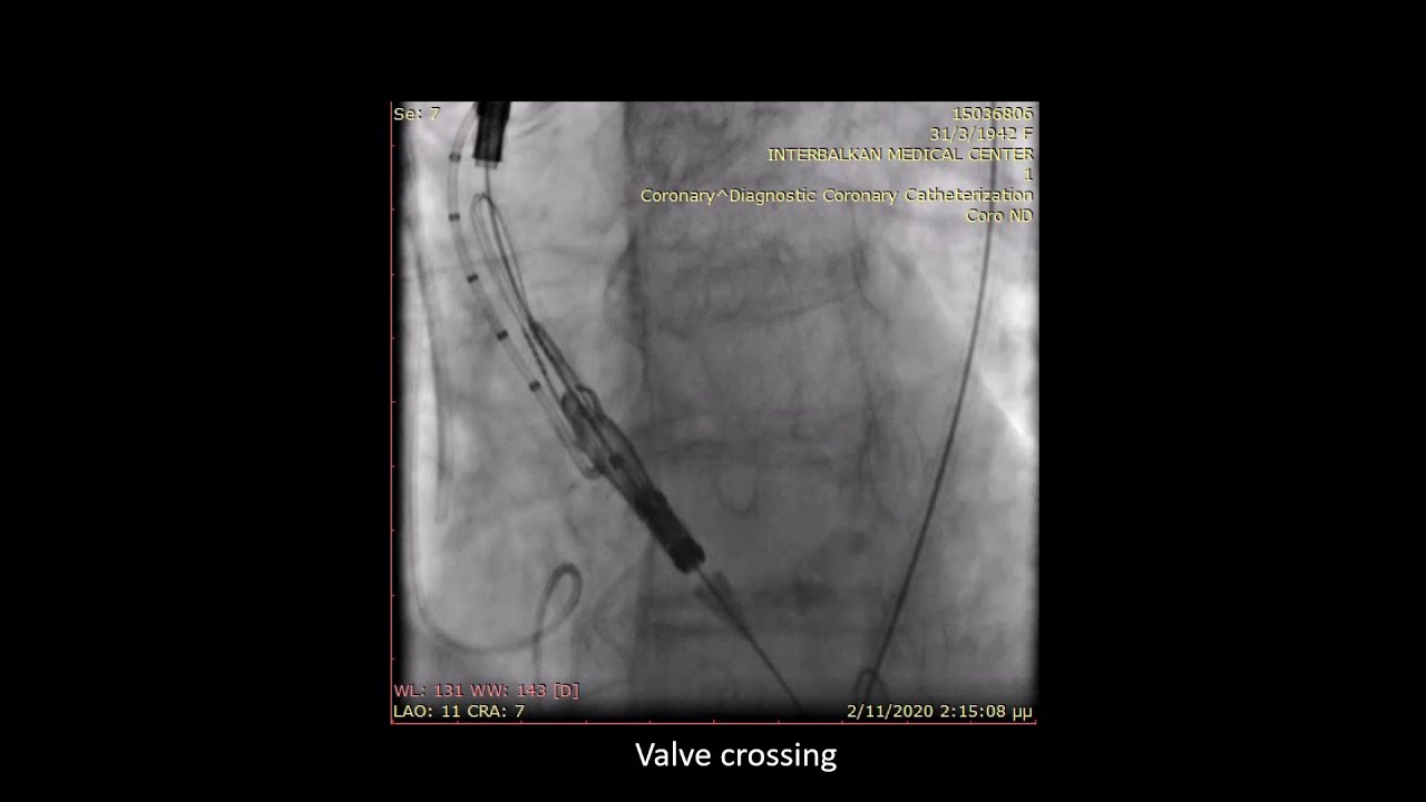 Transfemoral TAVI: Acurate Neo 2