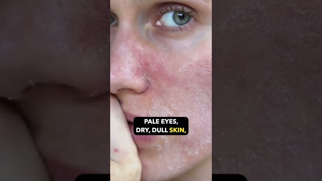 Vitamin B12 Deficiency: Symptoms, Causes, and Solutions! | Dr. Sarin |