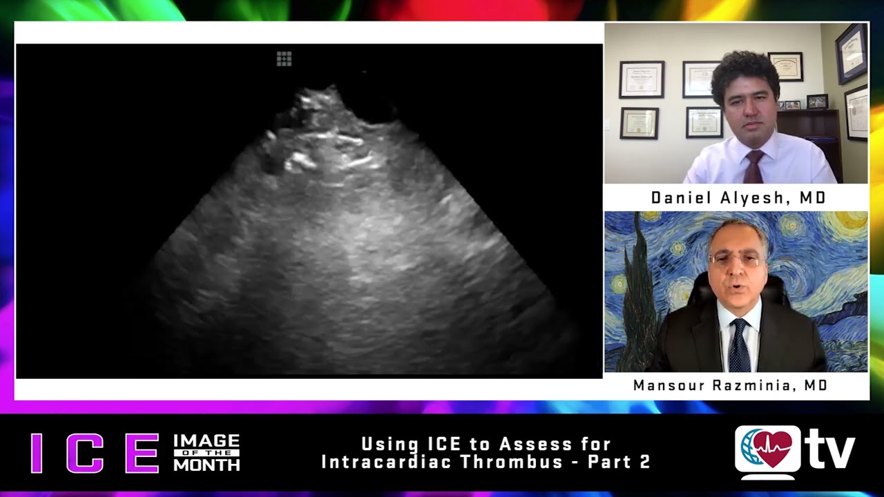 ICE Image of the Month (July 2022) Part II: Using ICE to Assess for Intracardiac Thrombus