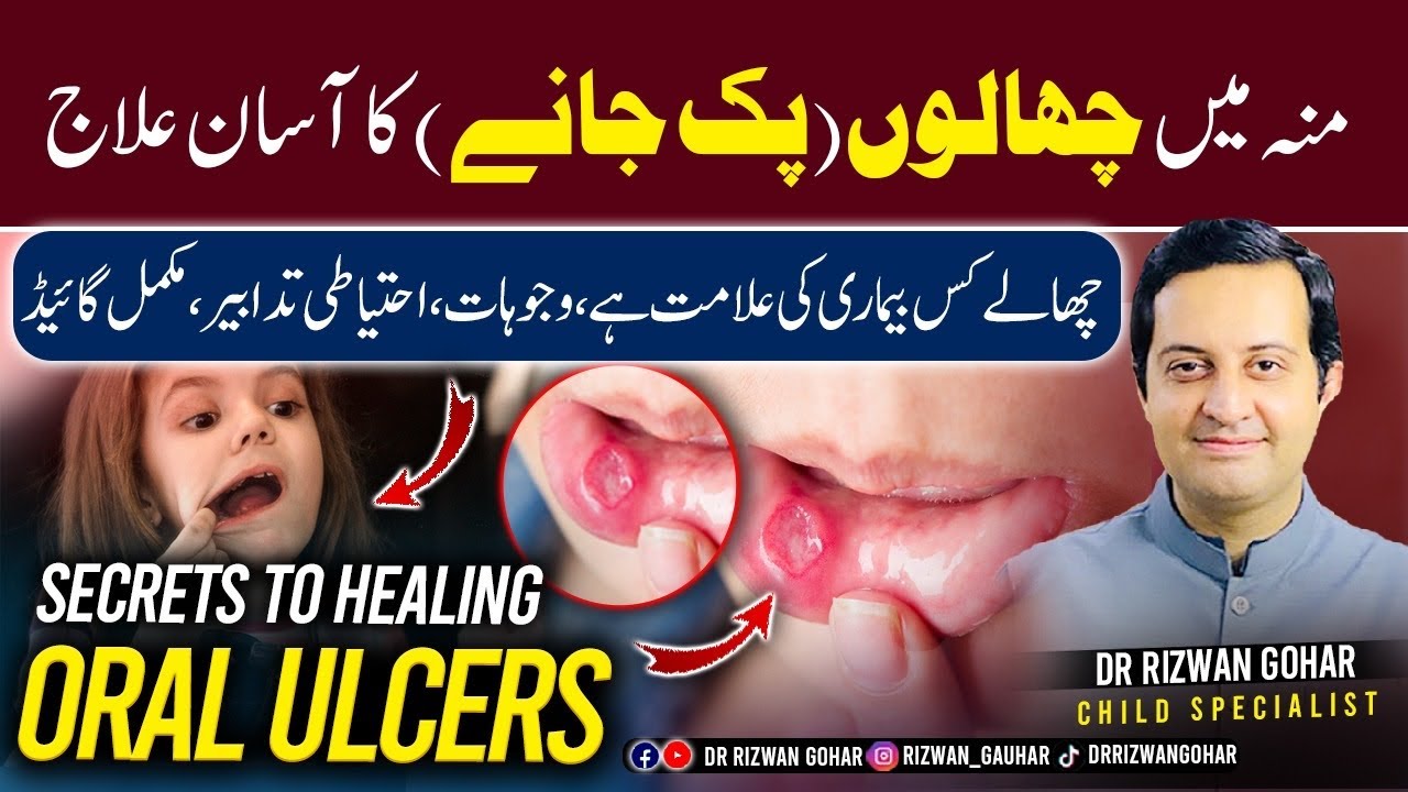 Secrets to Healing Oral Ulcers Fast #oral #ulcers #treatment