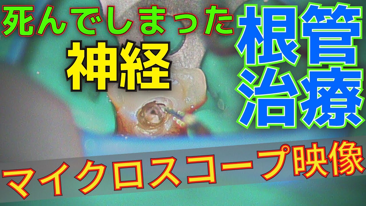 【マイクロスコープ映像】根管治療イニシャルトリートメントの実際の治療の様子ノーカット動画