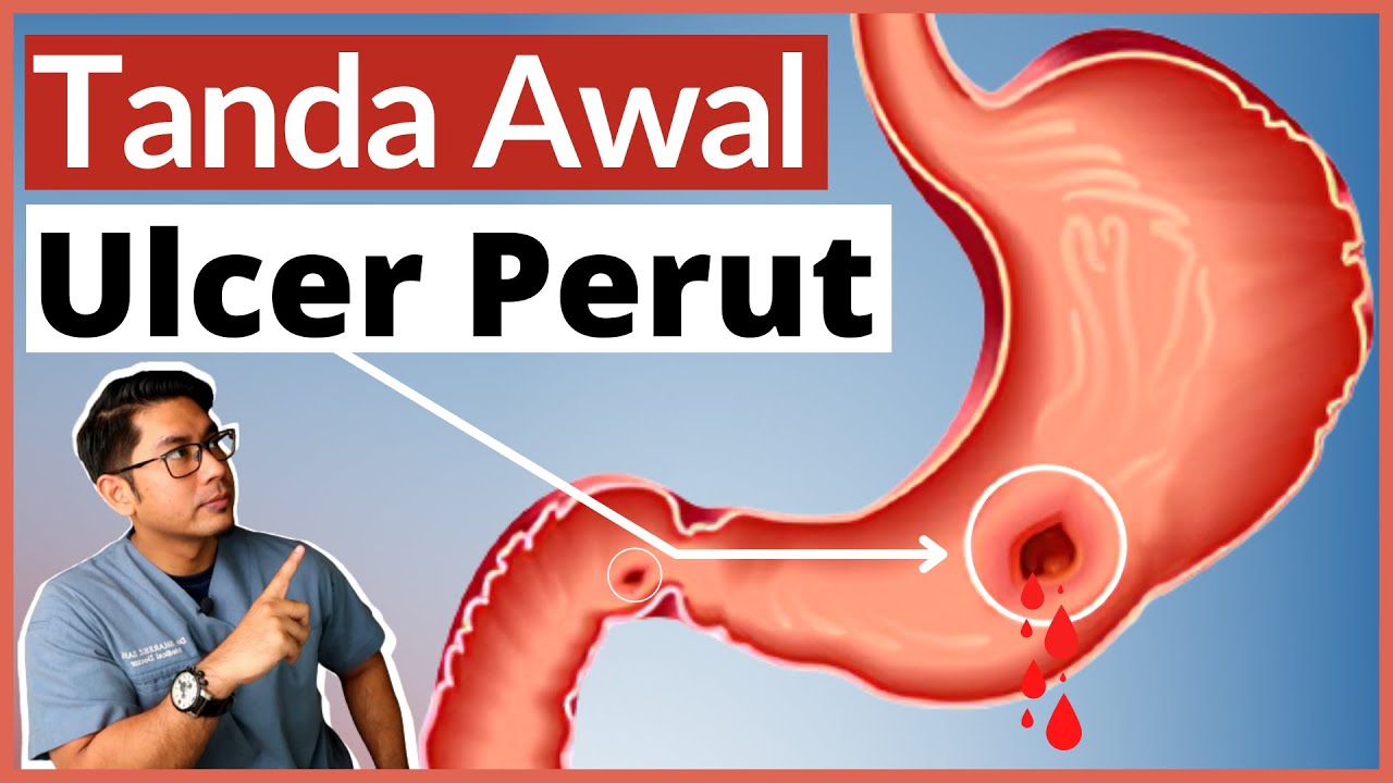 Ulcer Perut | Gastrik & Angin | 5 Tanda Awal Wajib Tahu | Doctor Sani |