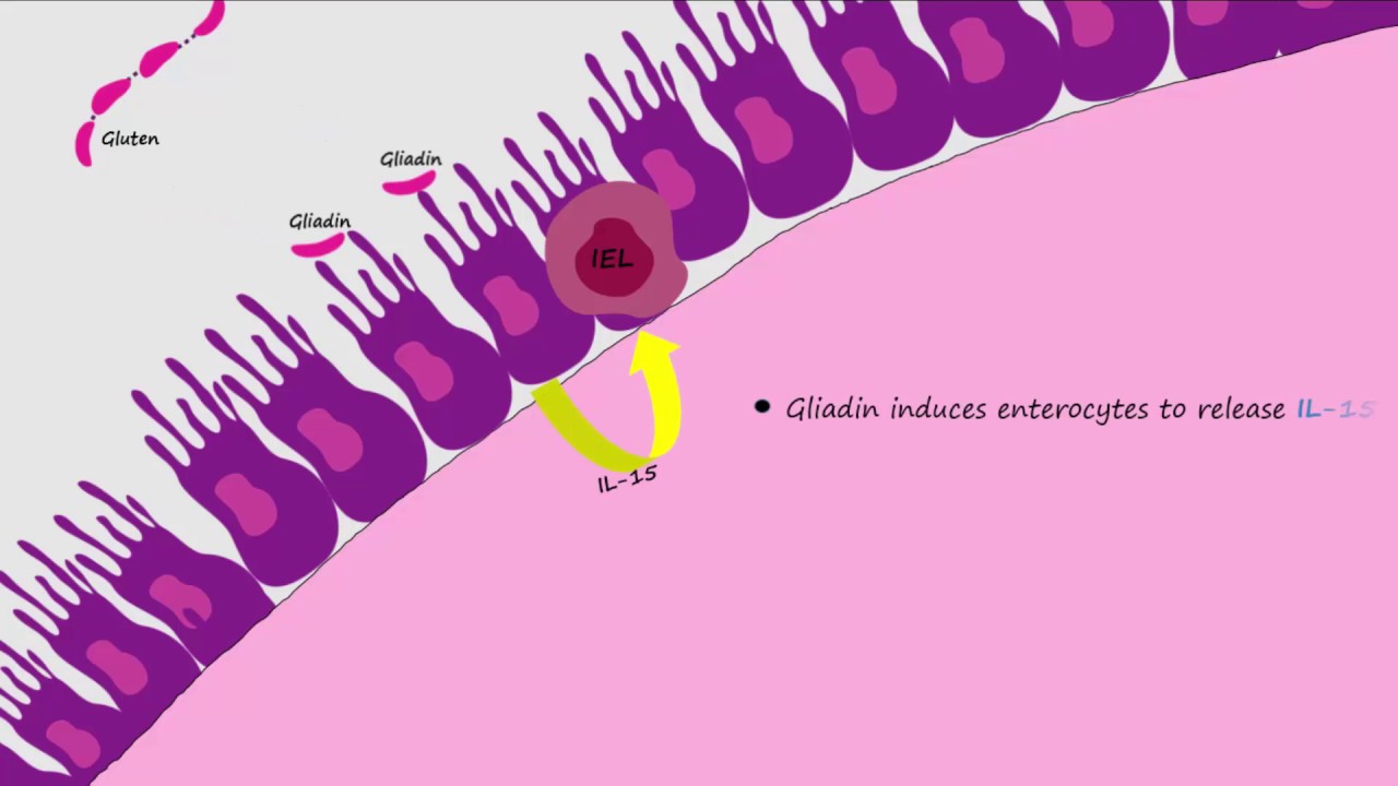 Celiac Disease Pathogenesis (Described Concisely and in Detail)