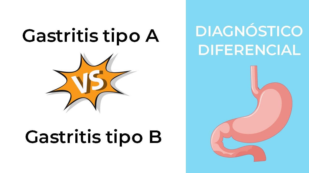 Diagnóstico Diferencial. Gastritis tipo A vs Gastritis tipo B