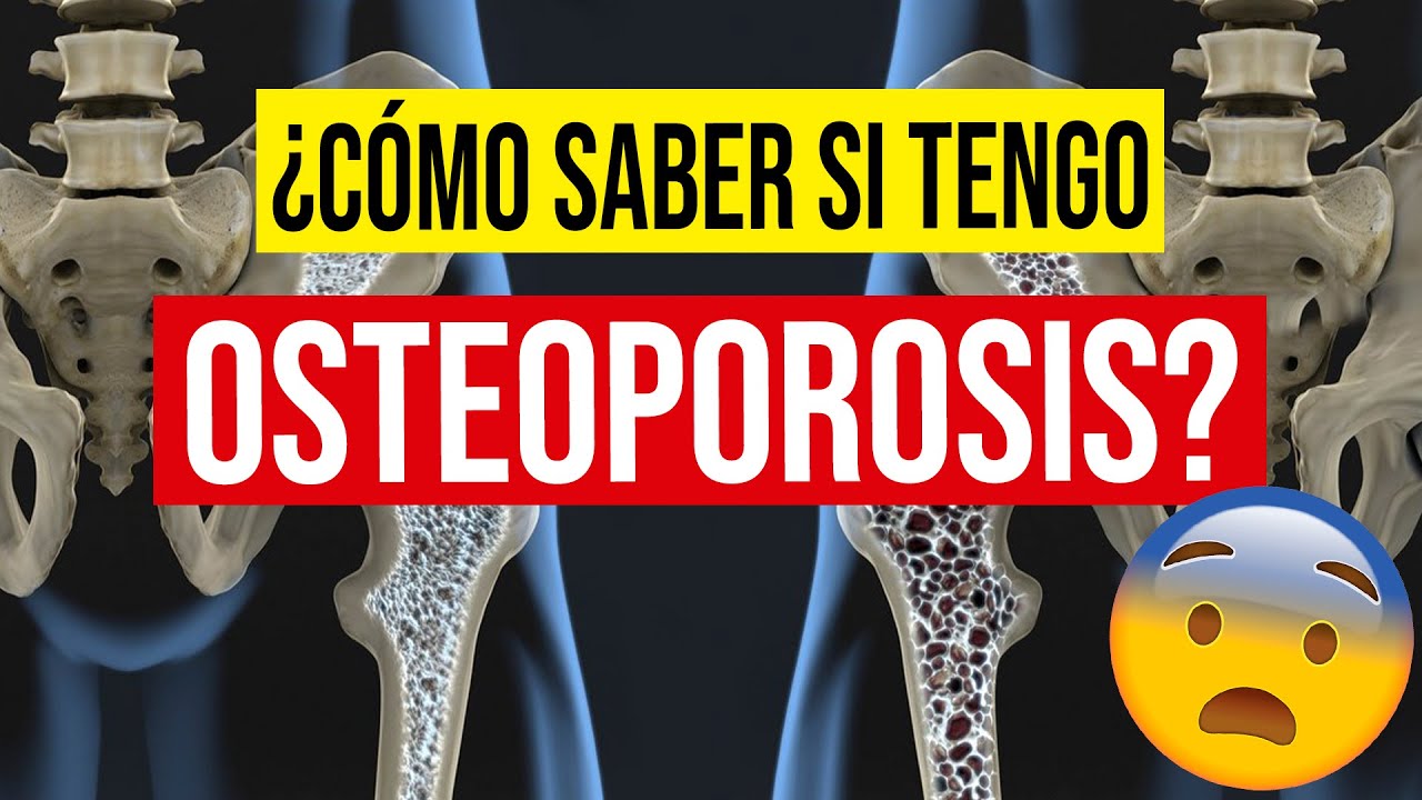 ⚠️ Conoce el RIESGO de padecer OSTEOPOROSIS 🆘 [Densitometría ósea]