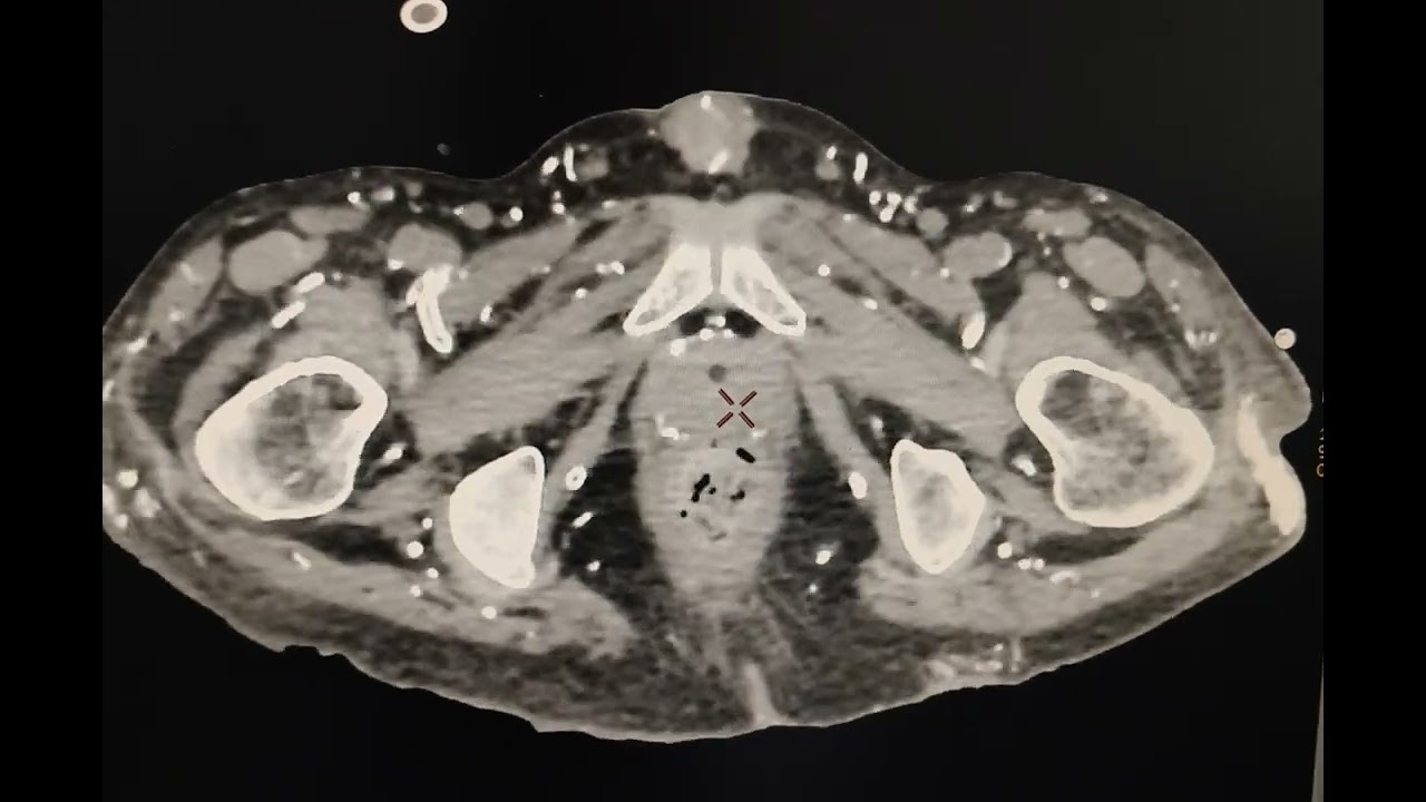 vascular and soft tissue calcifications in the visualized abdomen and pelvis.