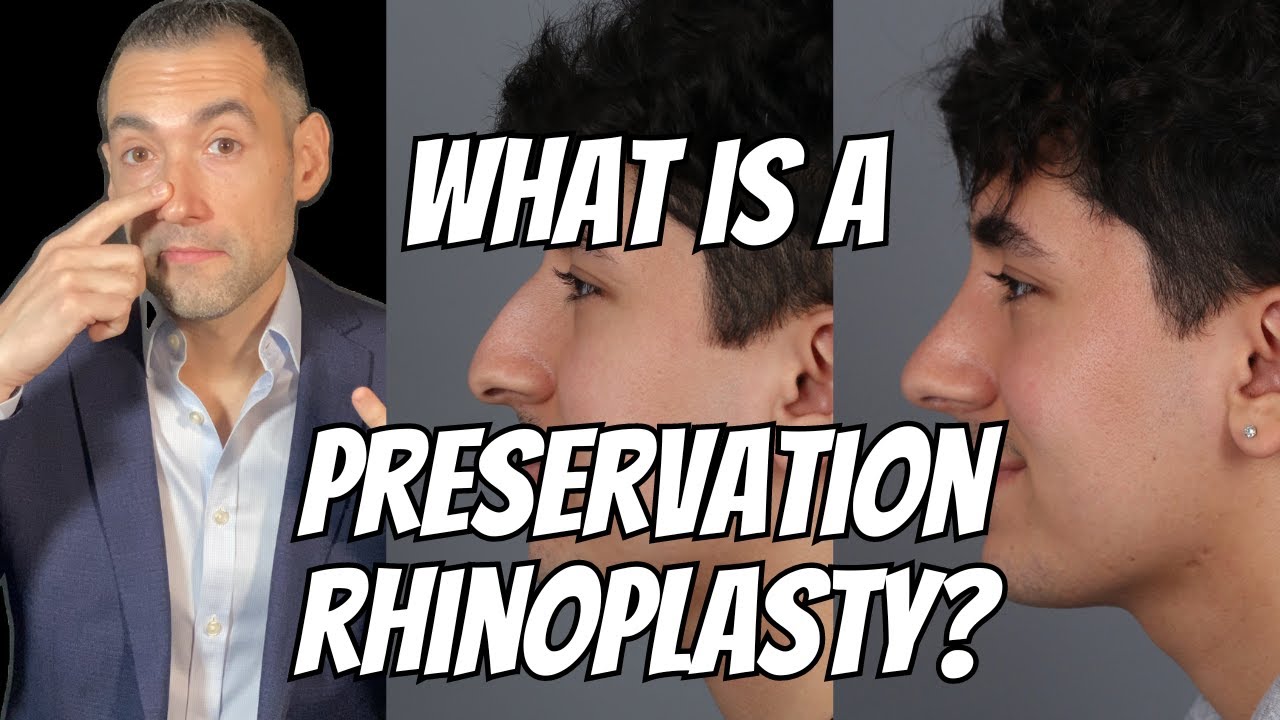 What is Preservation Rhinoplasty? Before and After with Dr. Vila