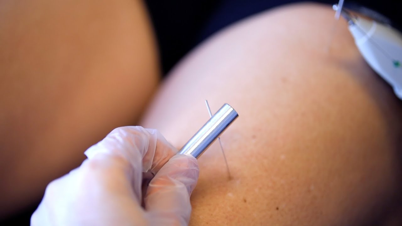 DRY NEEDLING GLUTES AND QUADS