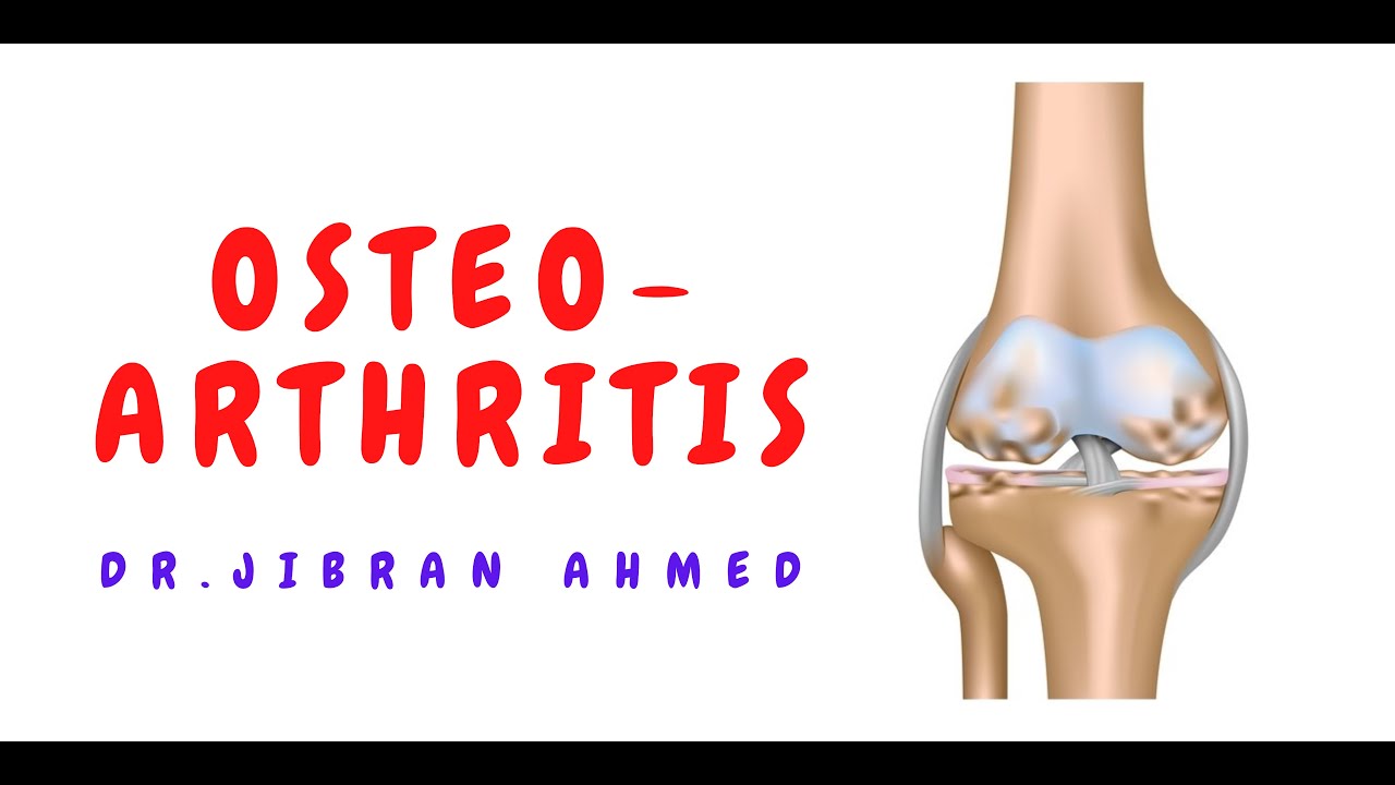 OSTEOARTHRITIS II BONES AND SOFT TISSUE II ARTHRITIS II ROBBINS 10TH E II PATHOLOGY LECTURES
