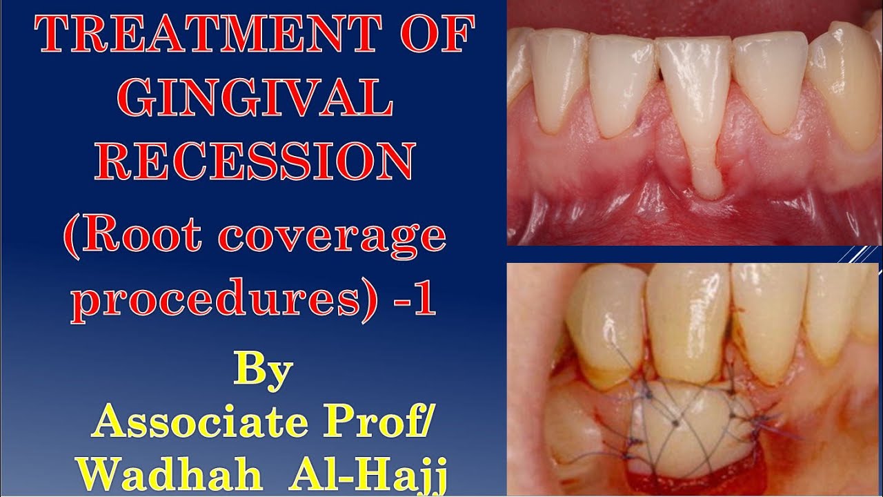 38-Periodontal surgery-7 (Treatment of gingival recession–Introduction (1)Wadhah Period lectures
