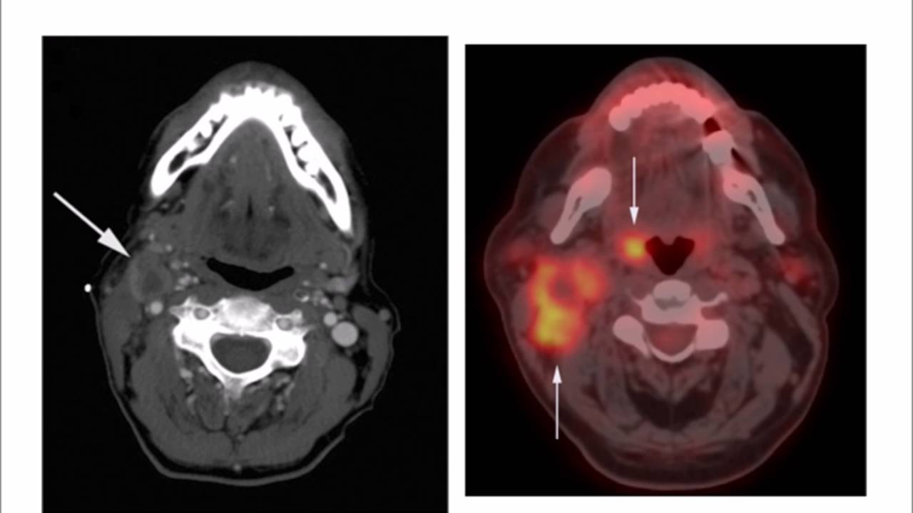 HPV and Oropharynx Cancer