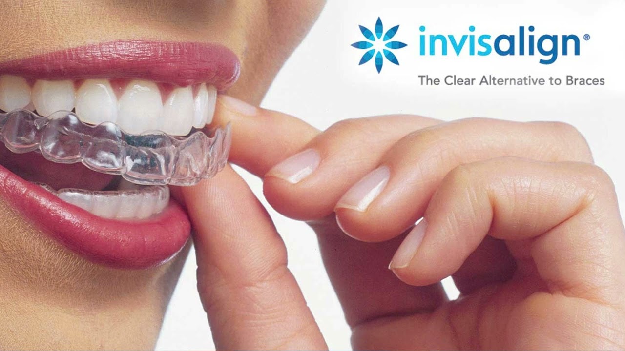 What is Invisalign?