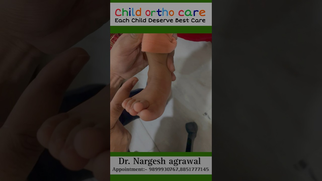 Best Clubfoot treatment in Delhi  ll टेडे मेड़े पाँव का इलाज #clubfootjourney #clubfoottreatment