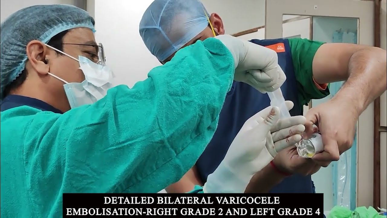 Detailed Bilateral Varicocele Embolisation-Right Grade 2 and left grade 4- Final