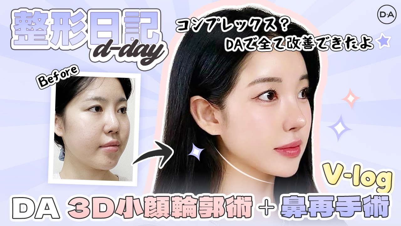 ［韓国整形］コンプレックスはDAに全てお任せしちゃおう！DA3D小顔輪郭術＋鼻再手術V LOG［DA美容外科］