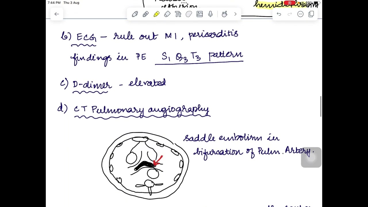 UPSC Medical Science optional previous year questions - Pulmonary Embolism