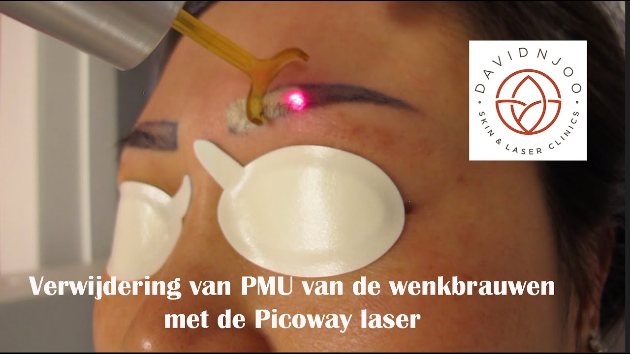 Verwijdering van PMU van de wenkbrauwen met de Picoway laser