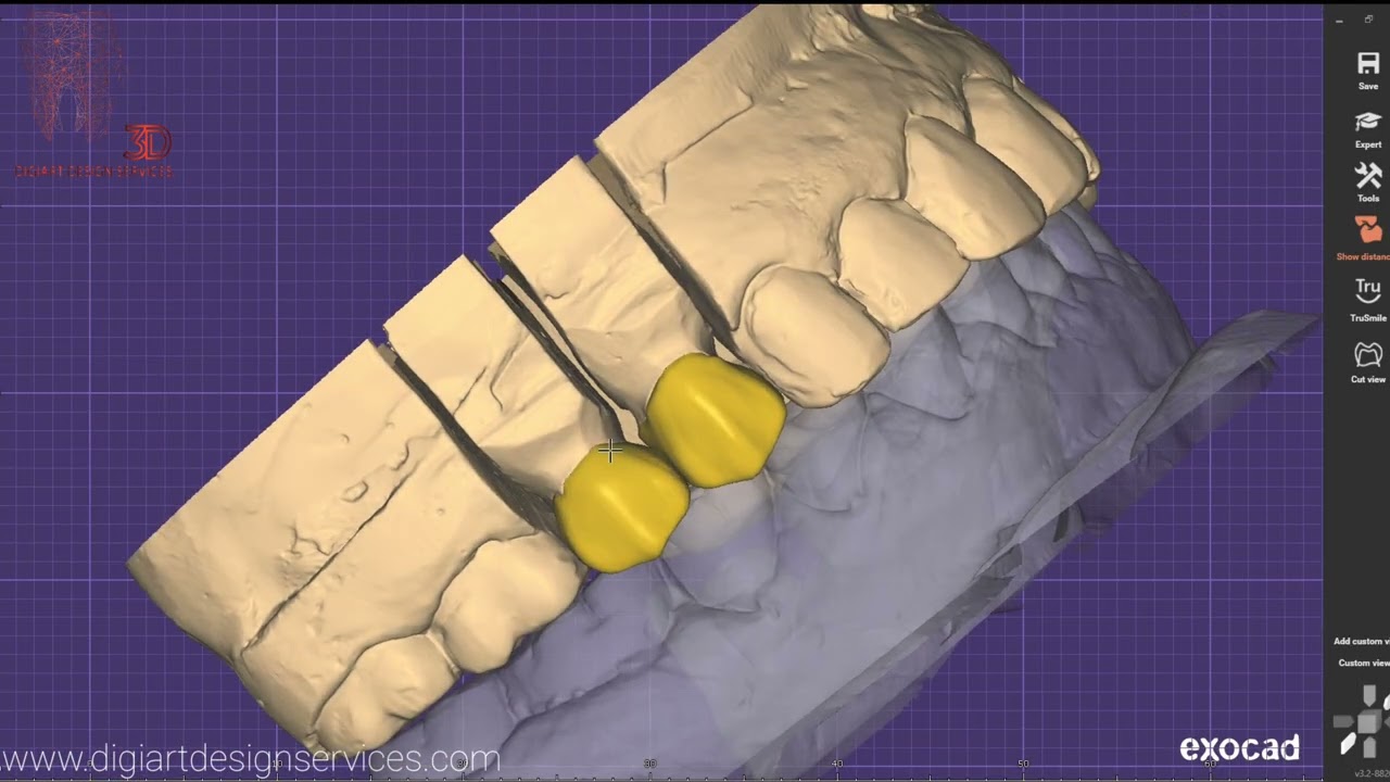 Step by Step tutorial how to design crown & bridge using Exocad