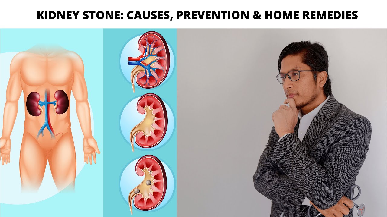 KIDNEY STONES: CAUSES, SYMPTOMS, PREVENTION & HOME REMEDIES (IN ROHINGYA LANGUAGE)