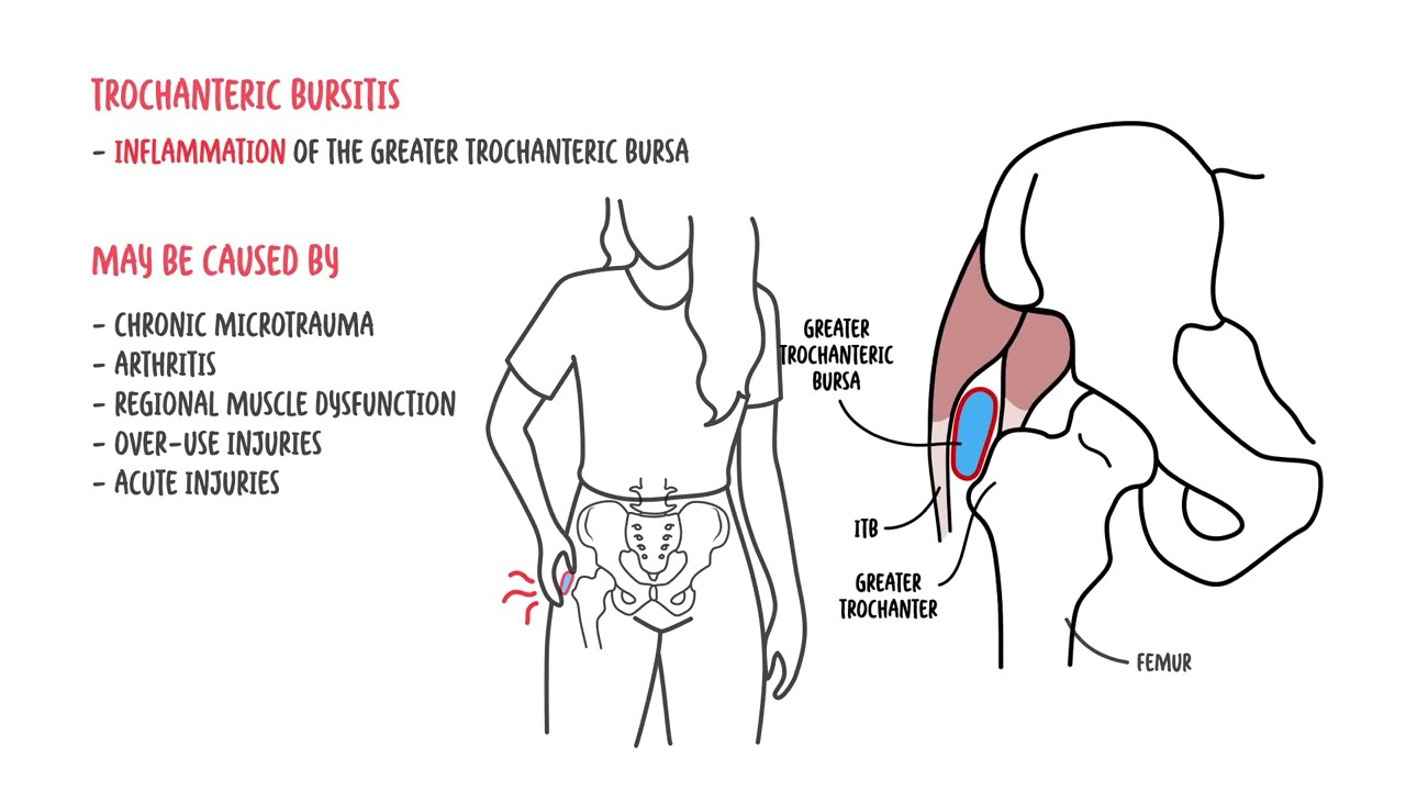 Understanding trochanteric bursitis