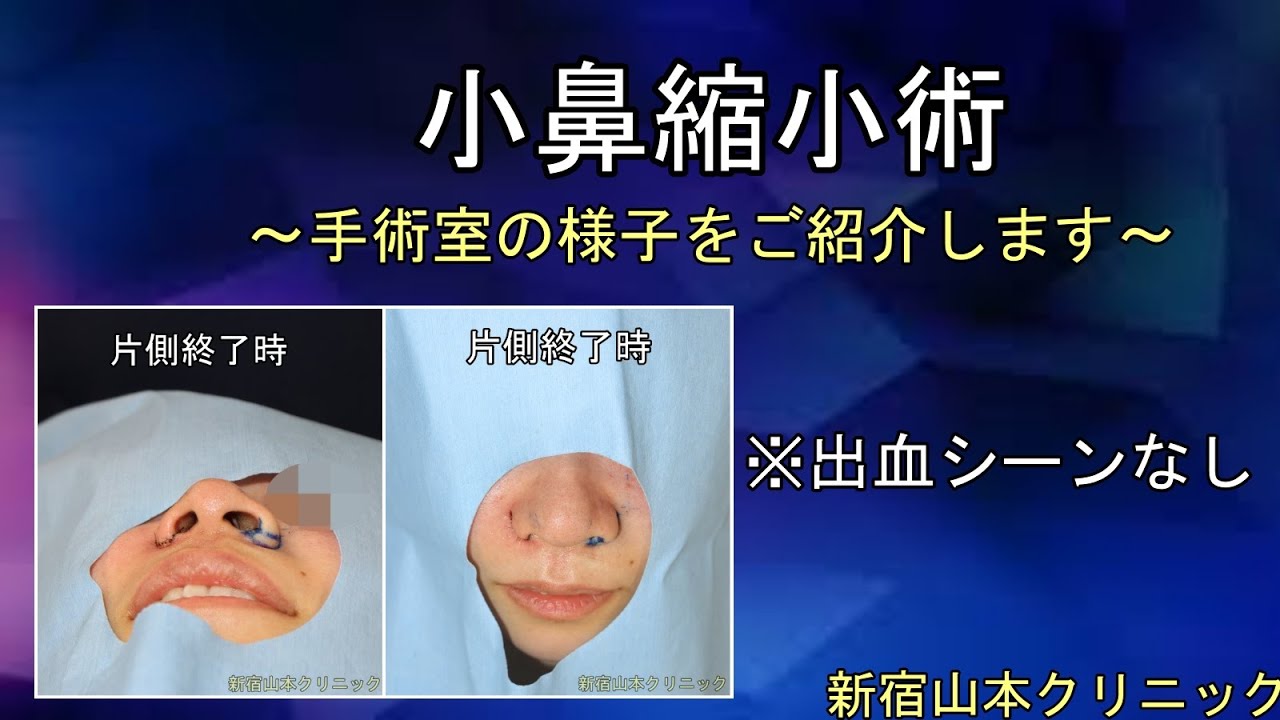 【小鼻縮小術直後、患者さんの感想】@山本クリニック