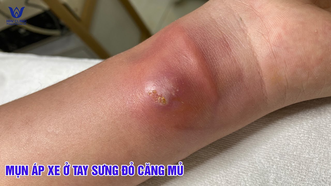 Mụn &aacute;p xe ở tay sưng đỏ căng mủ - đau nhức v&igrave; nhiễm tr&ugrave;ng s&acirc;u dưới da.