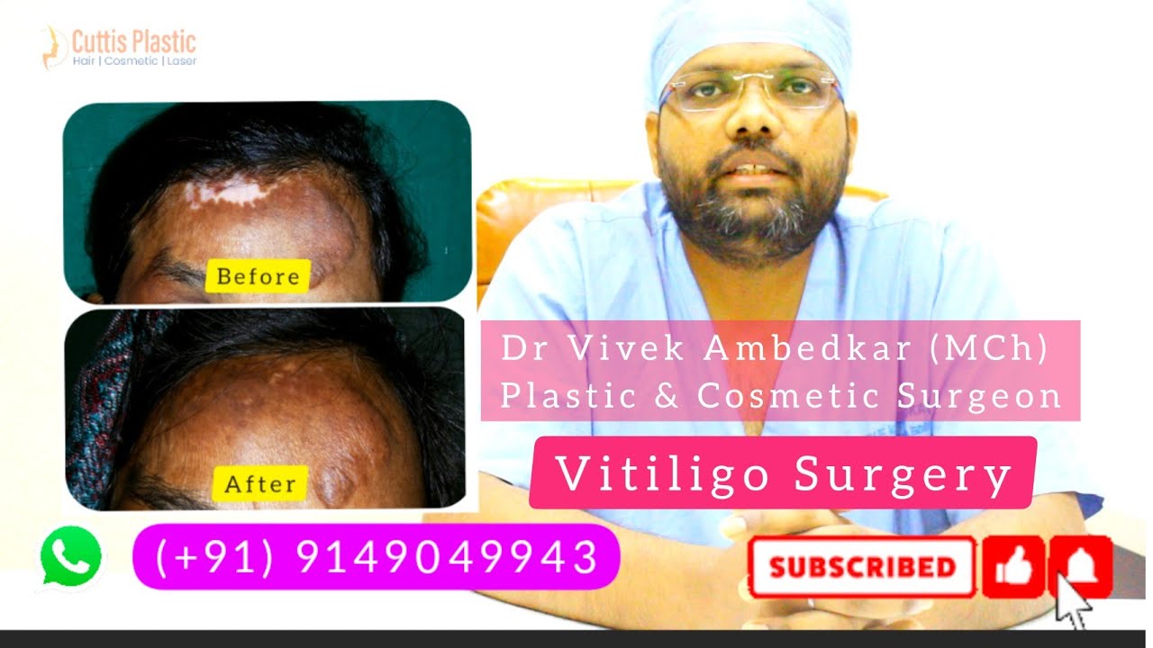 Vitiligo Surgery | सफ़ेद दाग का इलाज | Melanocytes Transfer Surgery | Bhopal Jabalpur Allahabad Rewa