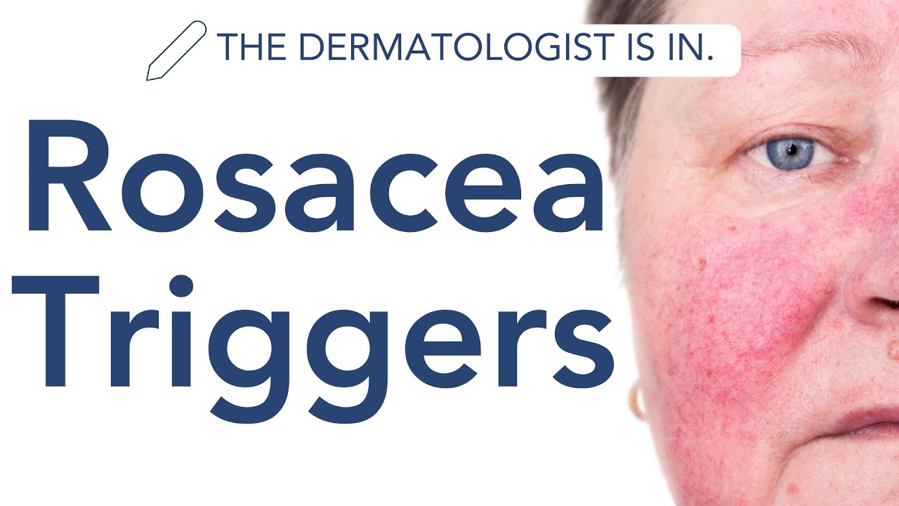 Rosacea Triggers - Complete Guide!