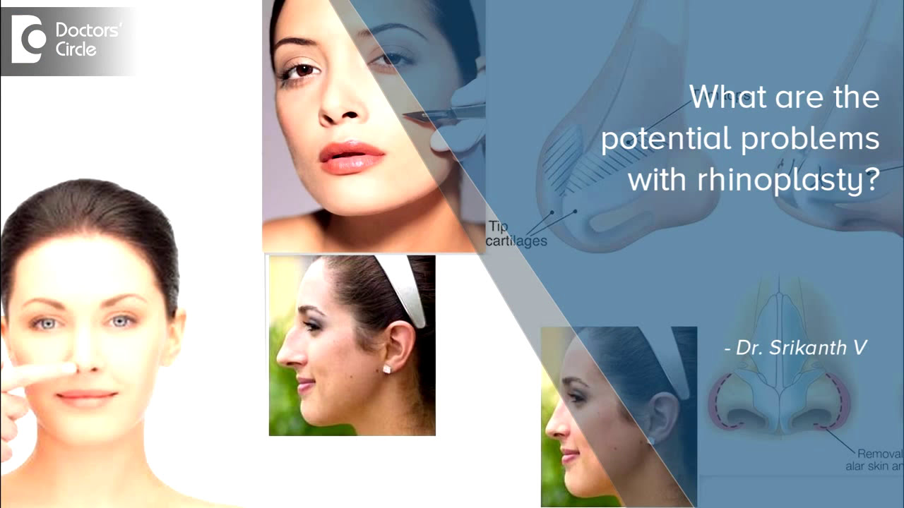 Potential Problems With Rhinoplasty | Plastic Surgery Hospital in Bangalore | Dr Srikanth V| Manipal