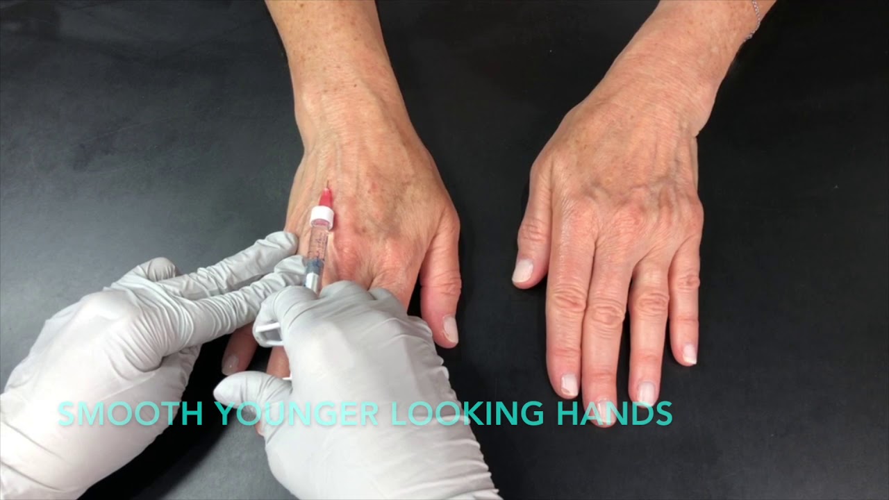 Filler for Hands