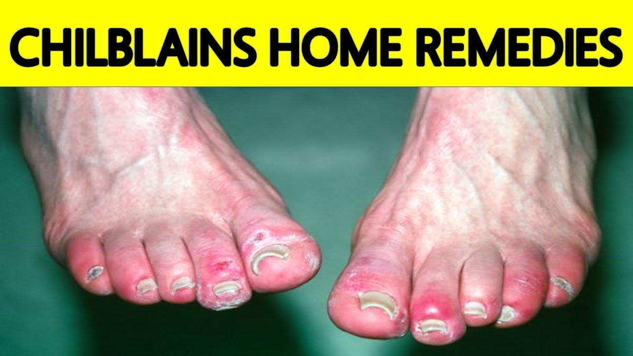 CHILBLAINS QUICK RELIEF | EASY HOME REMEDY FOR CHILBLAINS | CURE FOR SWOLLEN FINGERS DURING WINTER