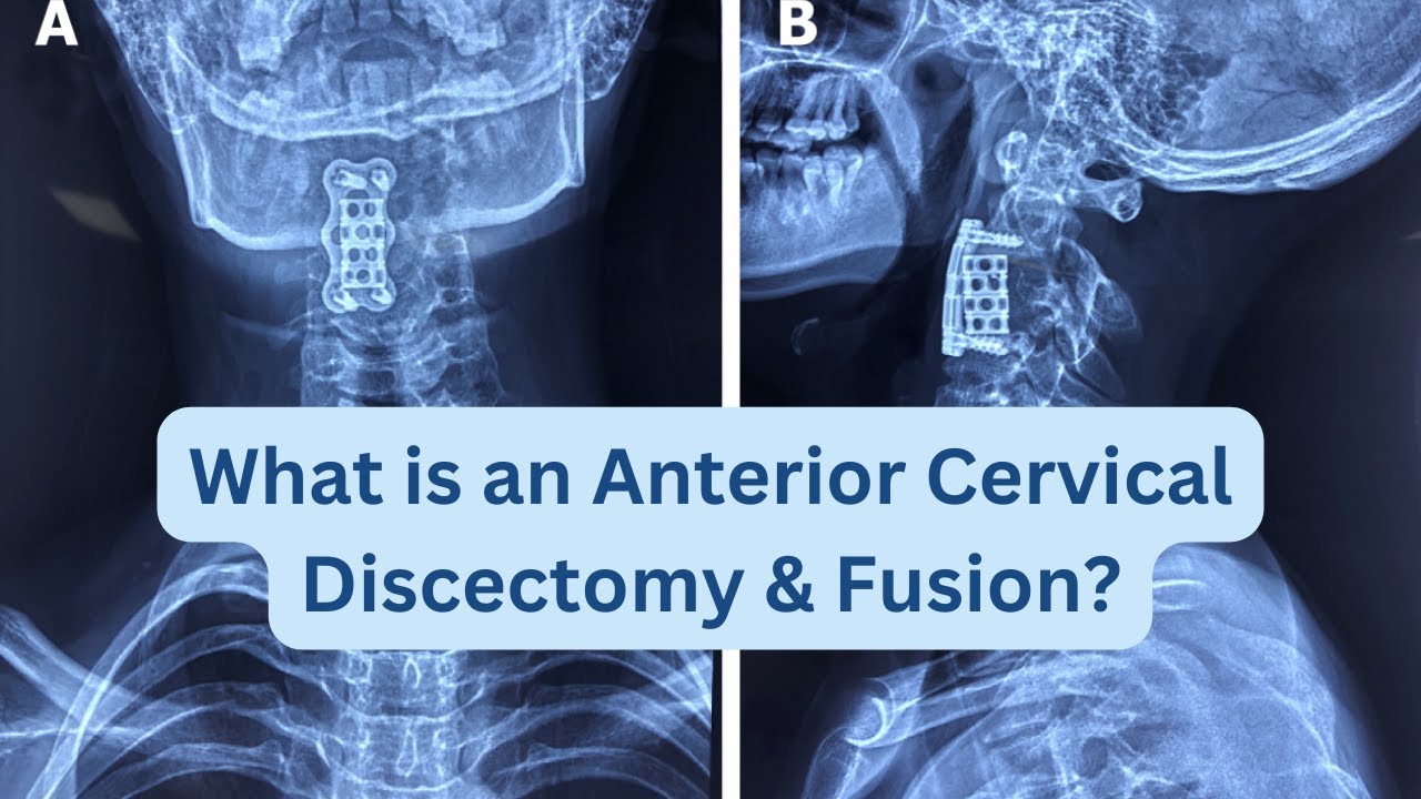 What is an Anterior Cervical Discectomy and Fusion?