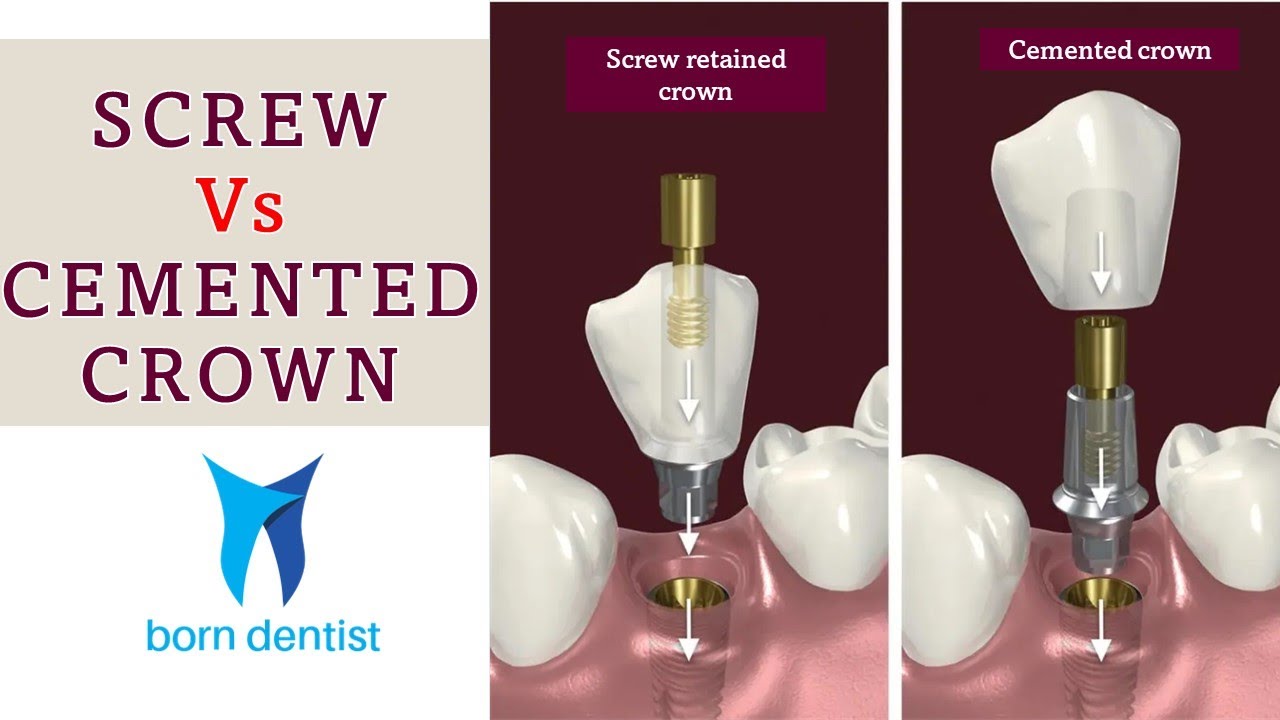 SCREW VS CEMENT RETAINED IMPLANT CROWN