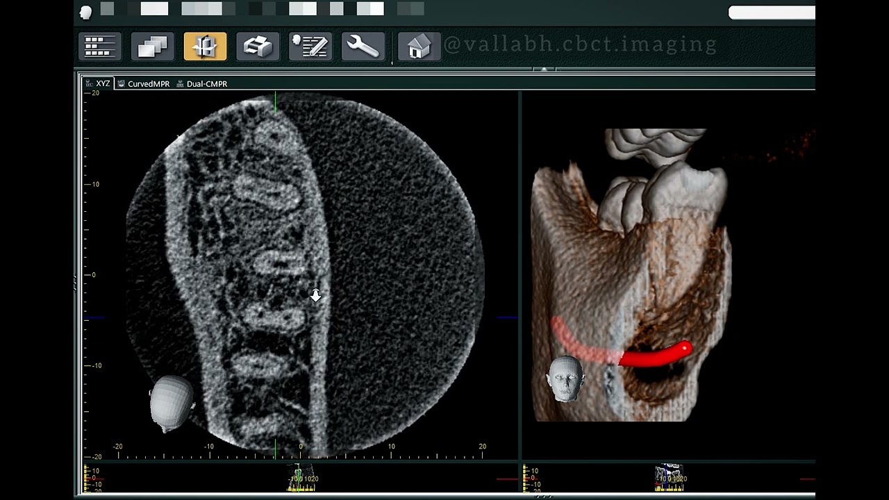 ROOT CANAL ANATOMY ENDODONTIC ASSESSMENT USING 3D CBCT TECHNOLOGY