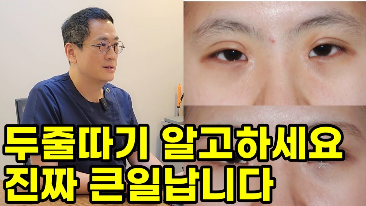 전문의가 정말 솔직하게 밝히는 쌍꺼풀재수술 두줄따기 알고 하셔야 합니다(부작용,실패,붓기,흉터,겹주름,후기)