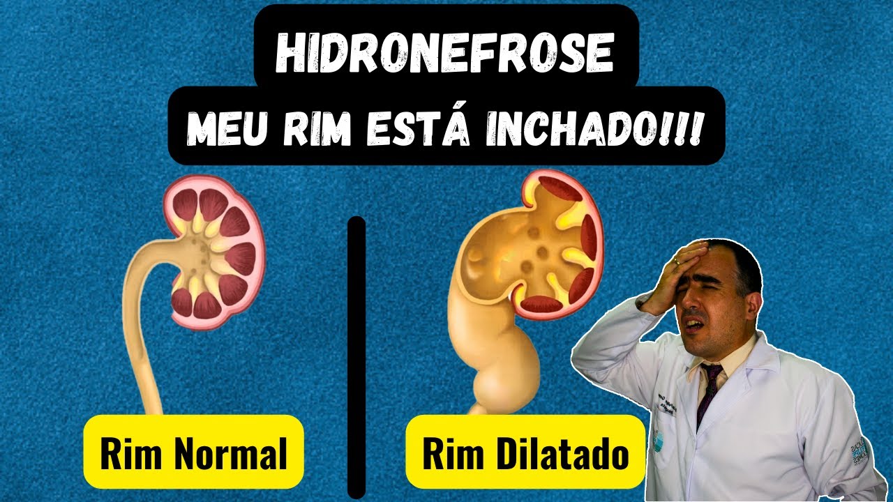 Hidronefrose: suas causas e poss&iacute;veis consequ&ecirc;ncias desse problema