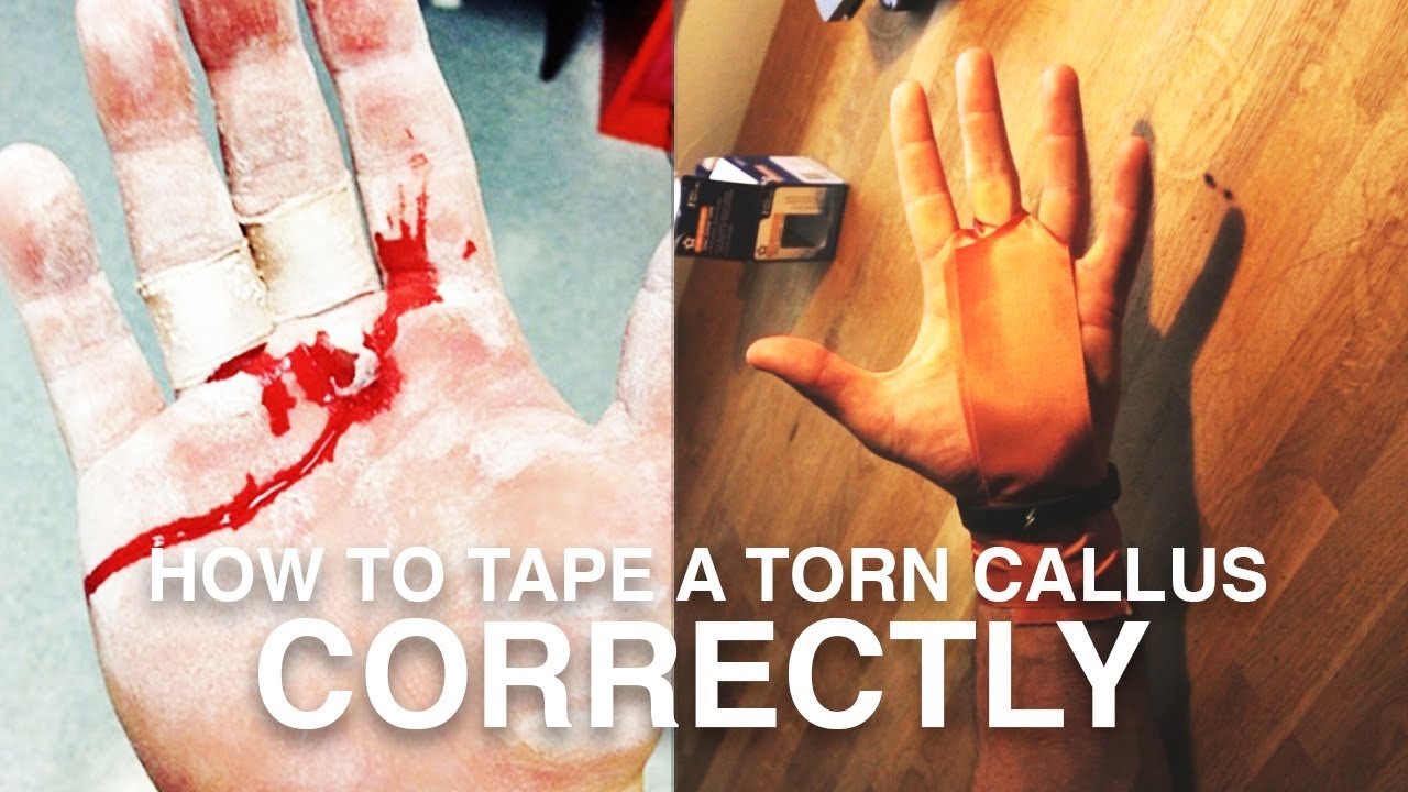 How To Tape A Torn Callus CORRECTLY | Parkour Tutorial
