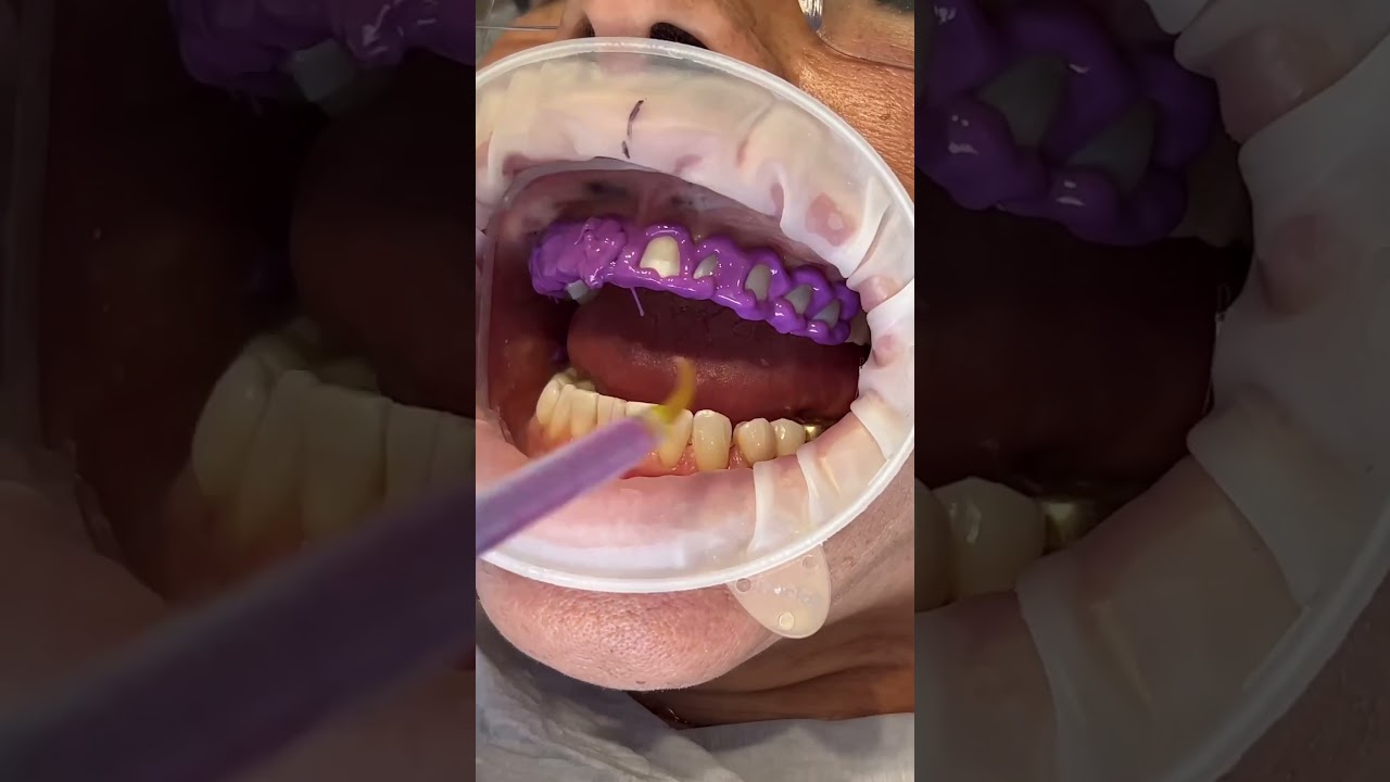 Biomimetic Esthetic Dentistry - Veneers PART I #biomimeticdentistry #veneers #estheticdentistry