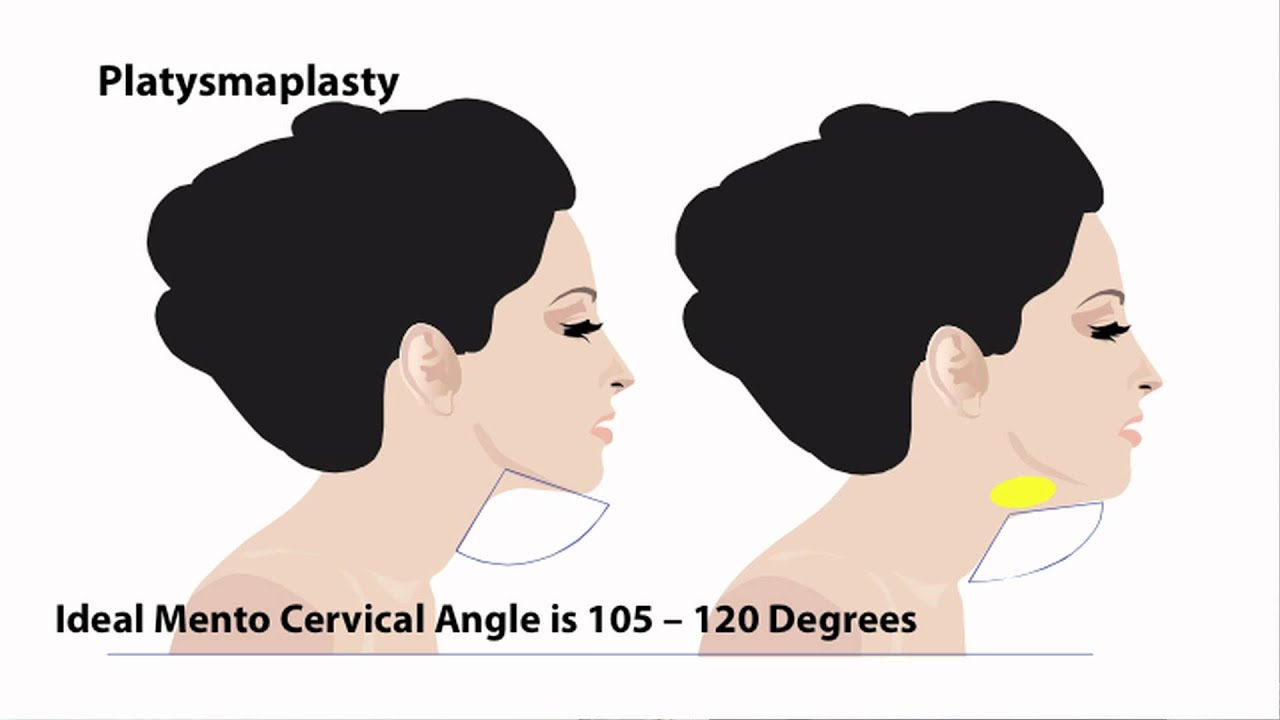 Part 13/13: Platysmaplasty Neck Tightening Surgery | Dr. Thomas Buonassisi, 8 West Clinic in BC