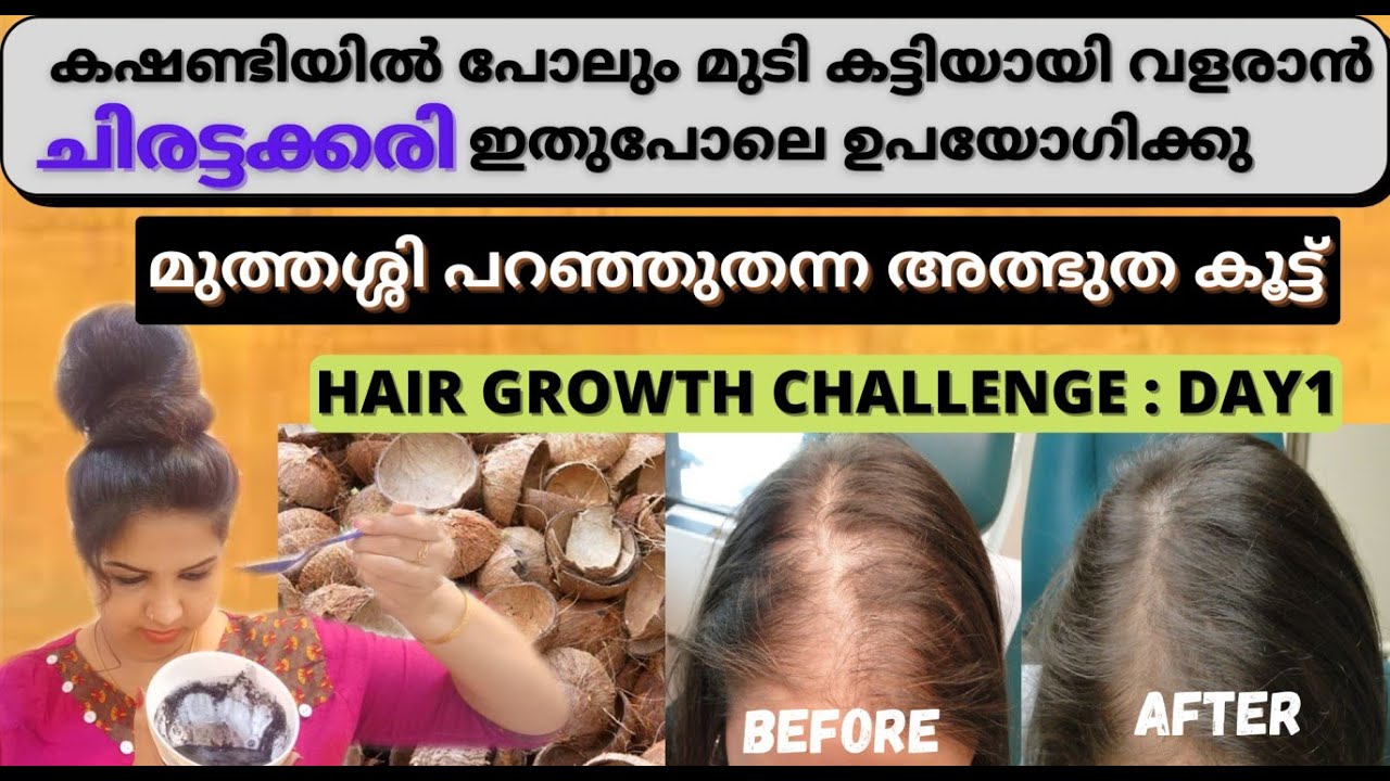 Day 1:Extreme THICk HAIR for all age group/മുത്തശ്ശിയുടെ Secrect tip/Cover Baldness just for 7 days💯